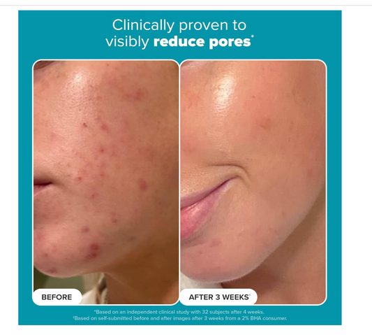 Paula's Choice: Skin Perfecting 2% BHA Liquid Toner