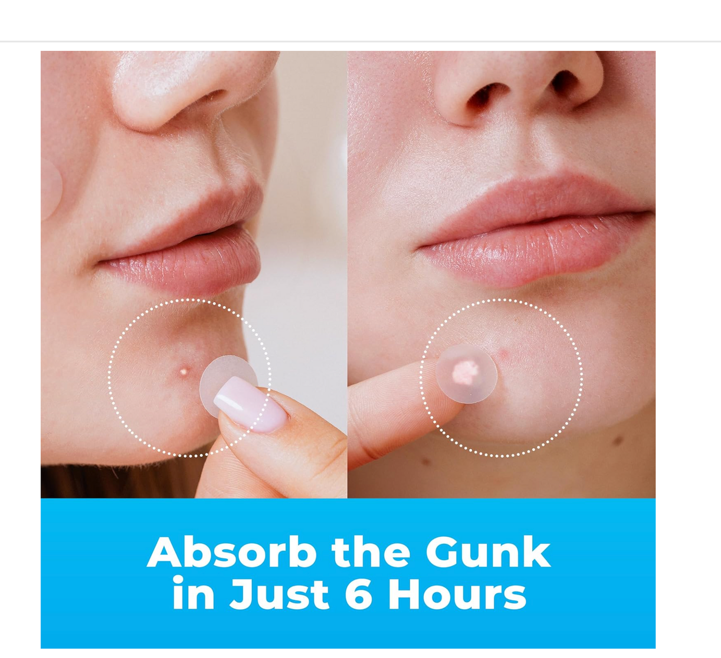 PatchRx Pimple Patches for Face (120 Patches), Hydrocolloid Pimple Patches