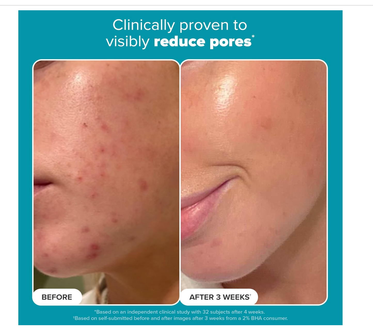 Paula's Choice: Skin Perfecting 2% BHA Liquid Toner